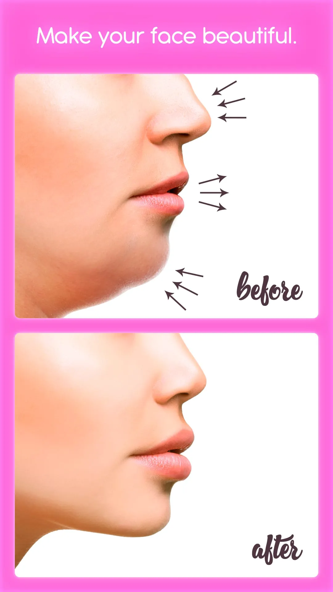 Rhinoplasty